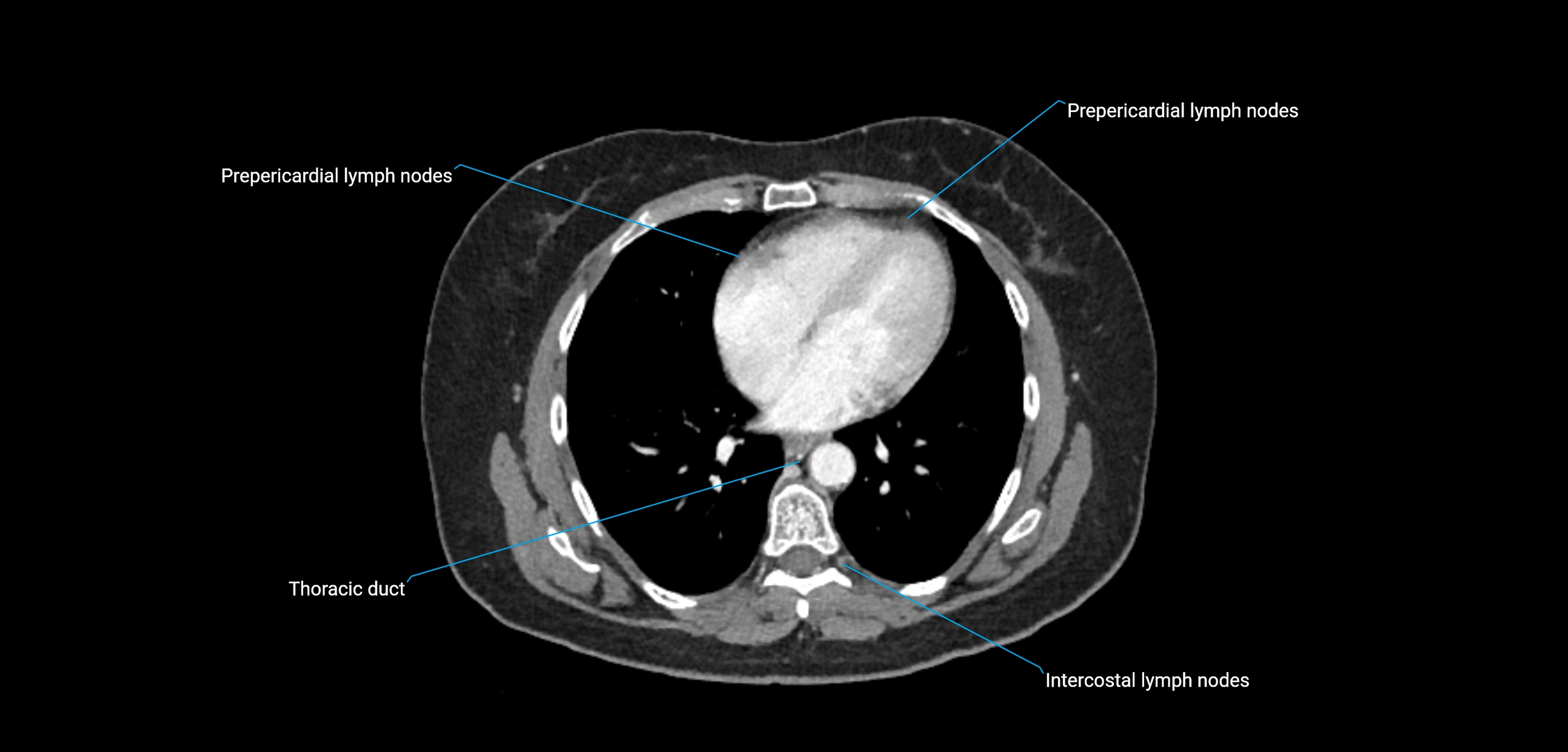 CT ct abdominal lymph nodes  axial cross sectional anatomy  enchanced radiology image -img-00002-00039.webp